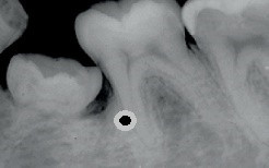 Lateral periodontal kist