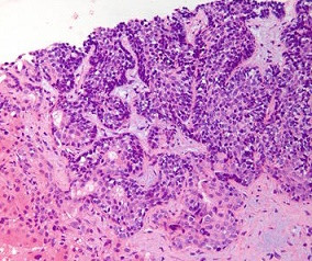 Malign ameloblastoma