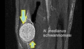 Schwannoma (nörinoma)