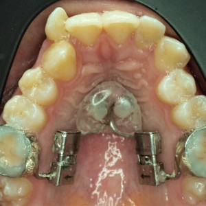 pal distalizer ile minivida destekli molar distalizasyonu