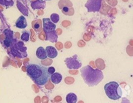 Paroksismal noktürnal hemoglobinuri