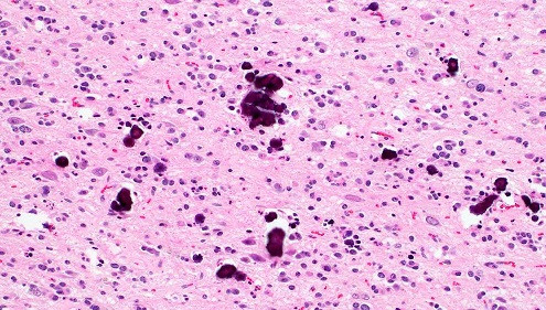 Oligodendroglioma