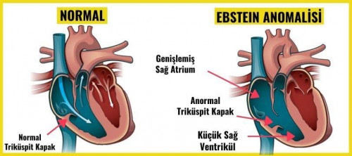 Ebstain anomalisi