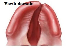 Yumuşak damak malformasyonları