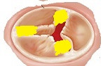 Kalp kapakları: Darlık (stenoz)