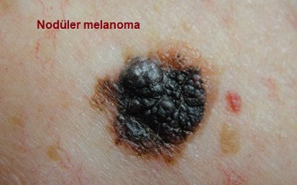 Malign melanoma