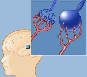 Galen ven malformasyonu - Galen anevrizmal malformasyonu