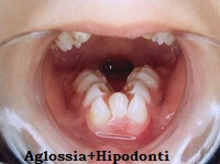 "Oromandibular limb hypogenesis" sendromları