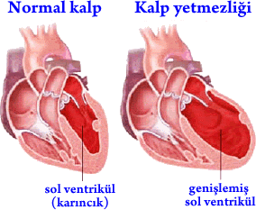 1) Sol Kalp Yetmezliği