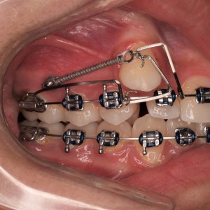 sliding jig for molar distalization