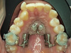 pal distalizer ile minivida destekli molar distalizasyonu