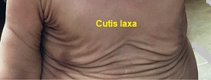 Cutis laxa