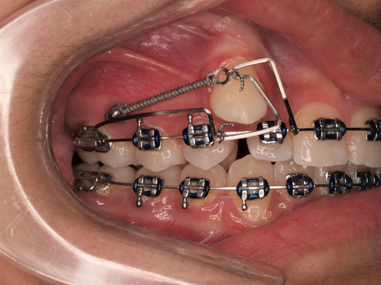 sliding jig for molar distalization