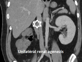 Renal agenez - Böbrek agenezi