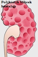 Renal hipertansiyon