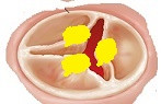 Kalp kapakları: Yetmezlik (rejürjitasyon)